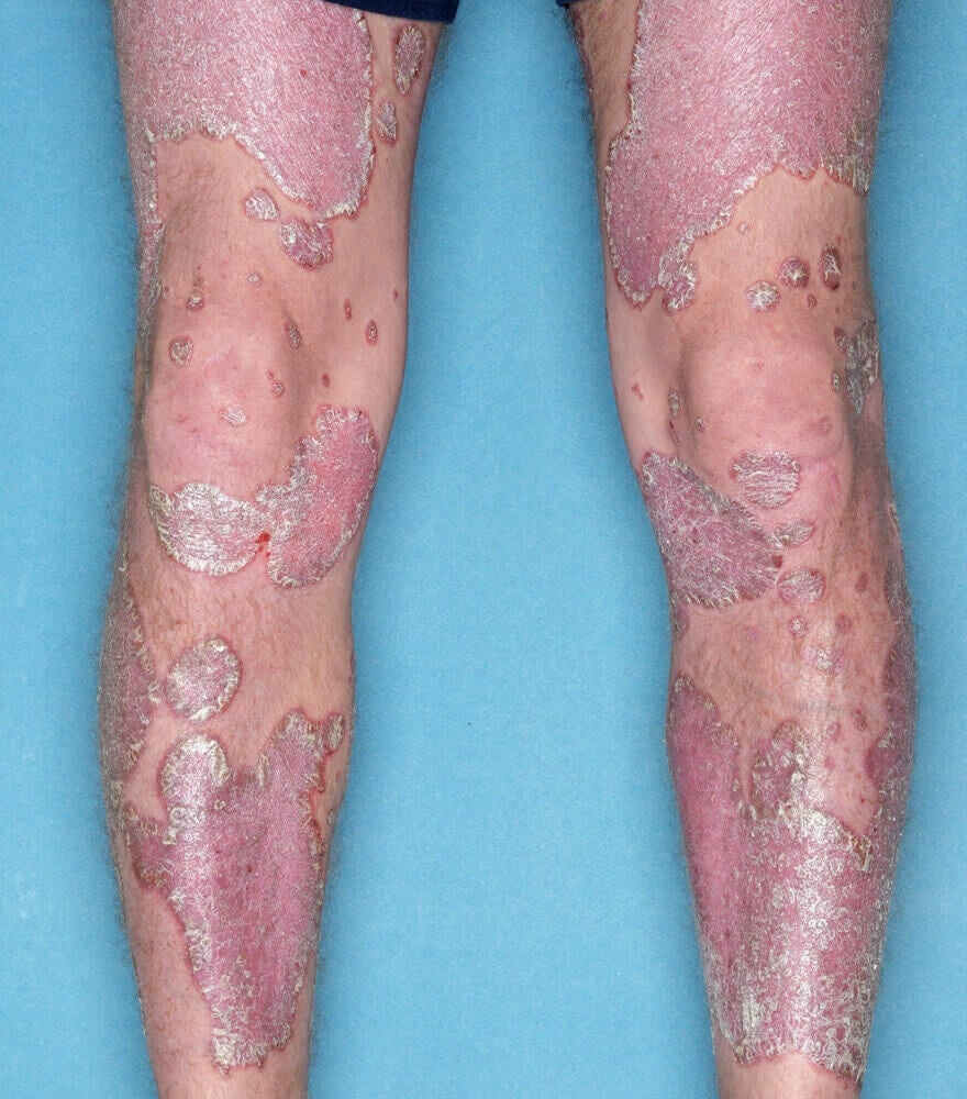 Psoriasis patient photos: 64% BSA before vs 0% BSA after 12 weeks with SILIQ