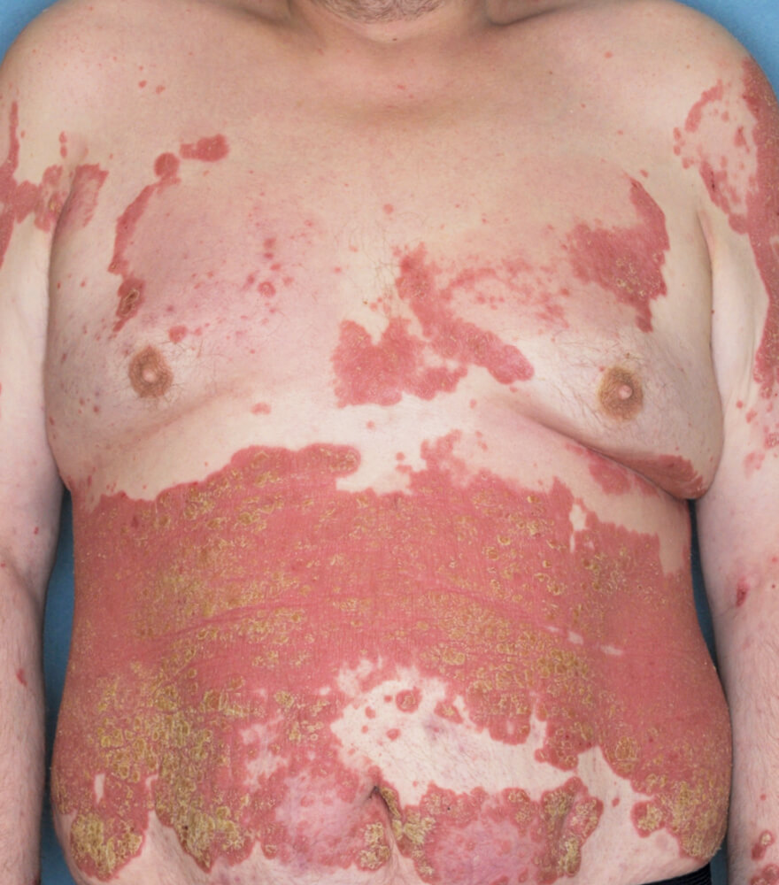 Psoriasis patient photos: 56% BSA before vs 0% BSA after 1 year with SILIQ
