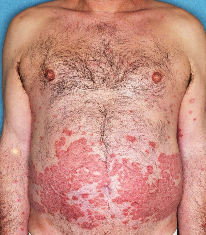 Psoriasis patient photos 28% BSA before vs 0% BSA after 3 months with SILIQ