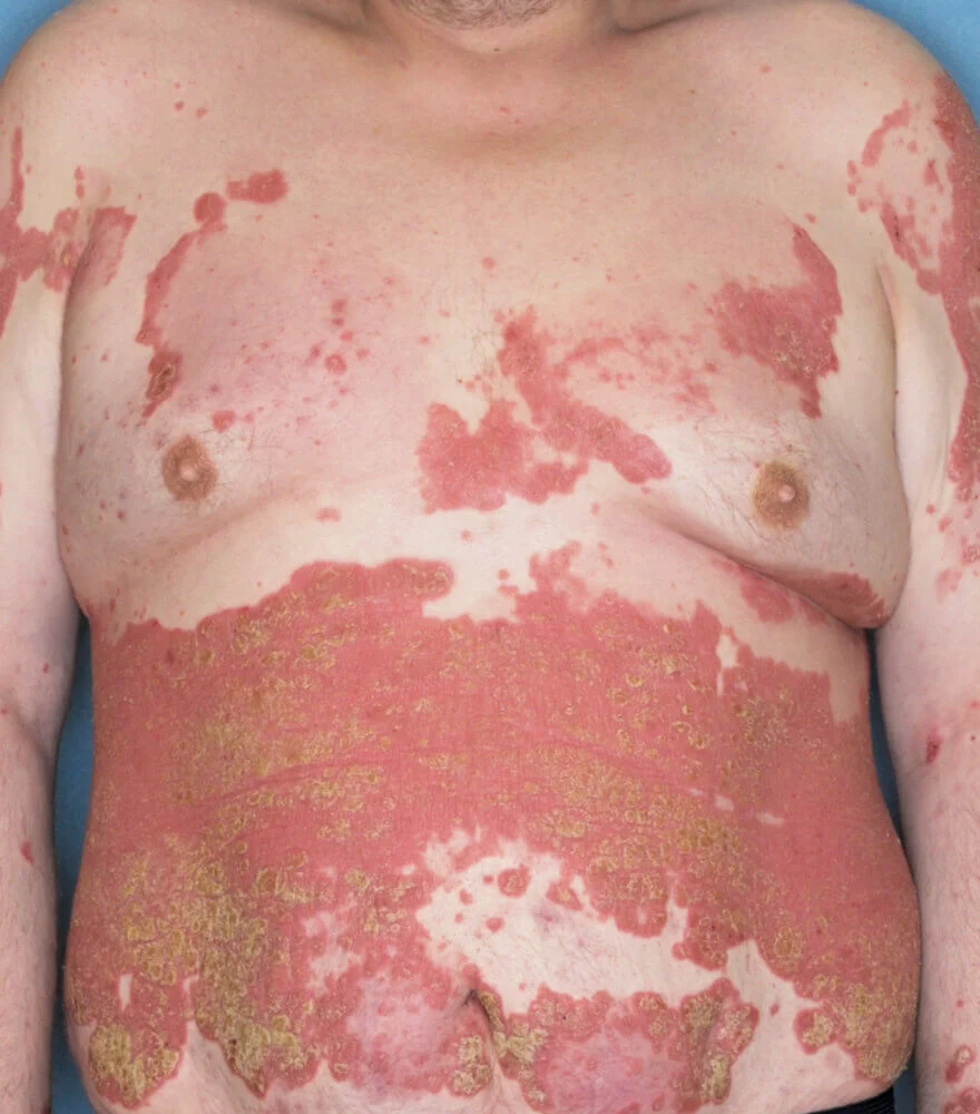 Psoriasis patient photos: 56% BSA before vs 0% BSA after 52 weeks with SILIQ