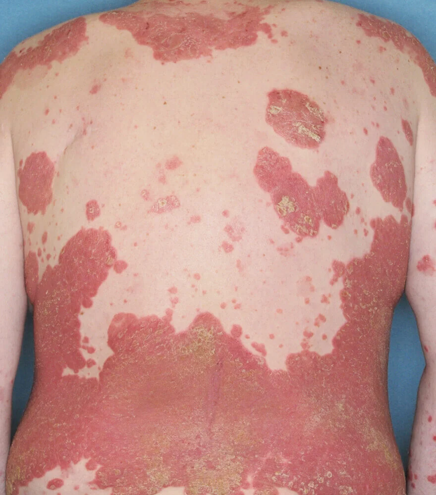 Psoriasis patient photos: 56% BSA before vs 0% BSA after 52 weeks with SILIQ