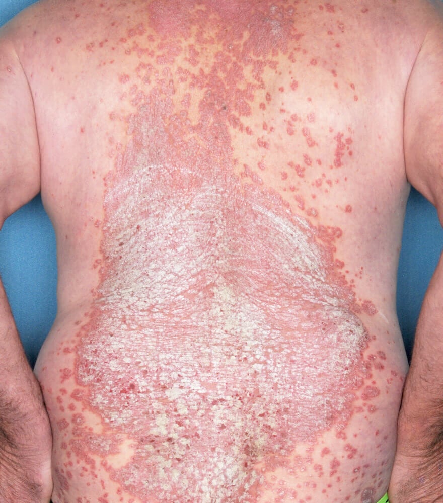Psoriasis patient photos: 16.5% BSA before vs 0% BSA after 52 weeks with SILIQ