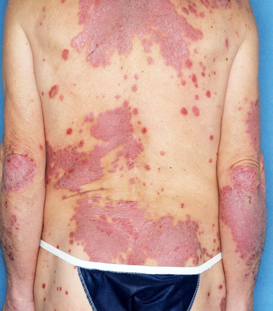 Psoriasis patient photos: 50% BSA before vs 0% BSA after 52 weeks with SILIQ