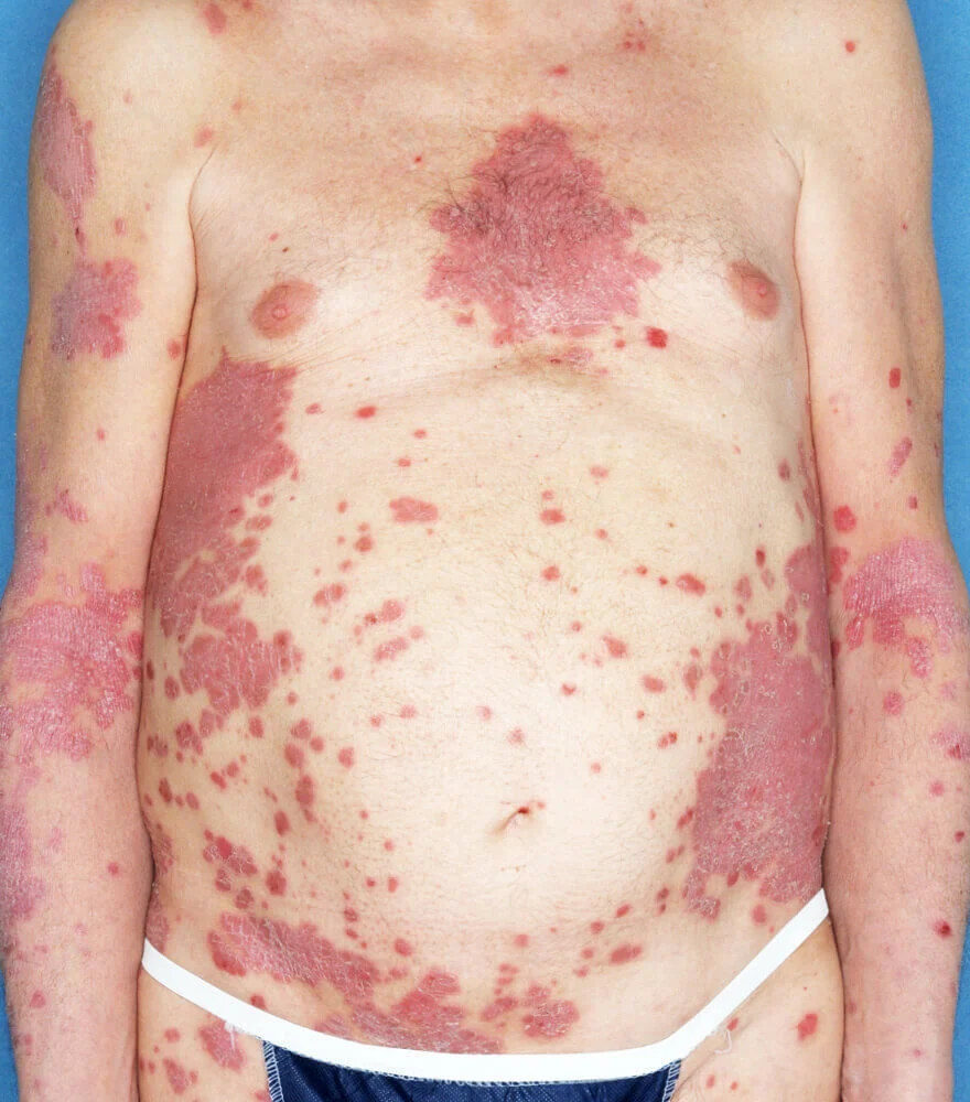 Psoriasis patient photos: 50% BSA before vs 0% BSA after 52 weeks with SILIQ