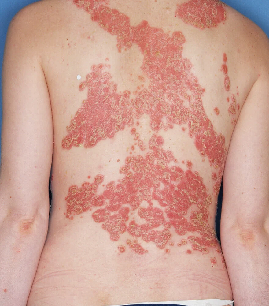 Psoriasis patient photos: 23% BSA before vs 0% BSA after 52 weeks with SILIQ