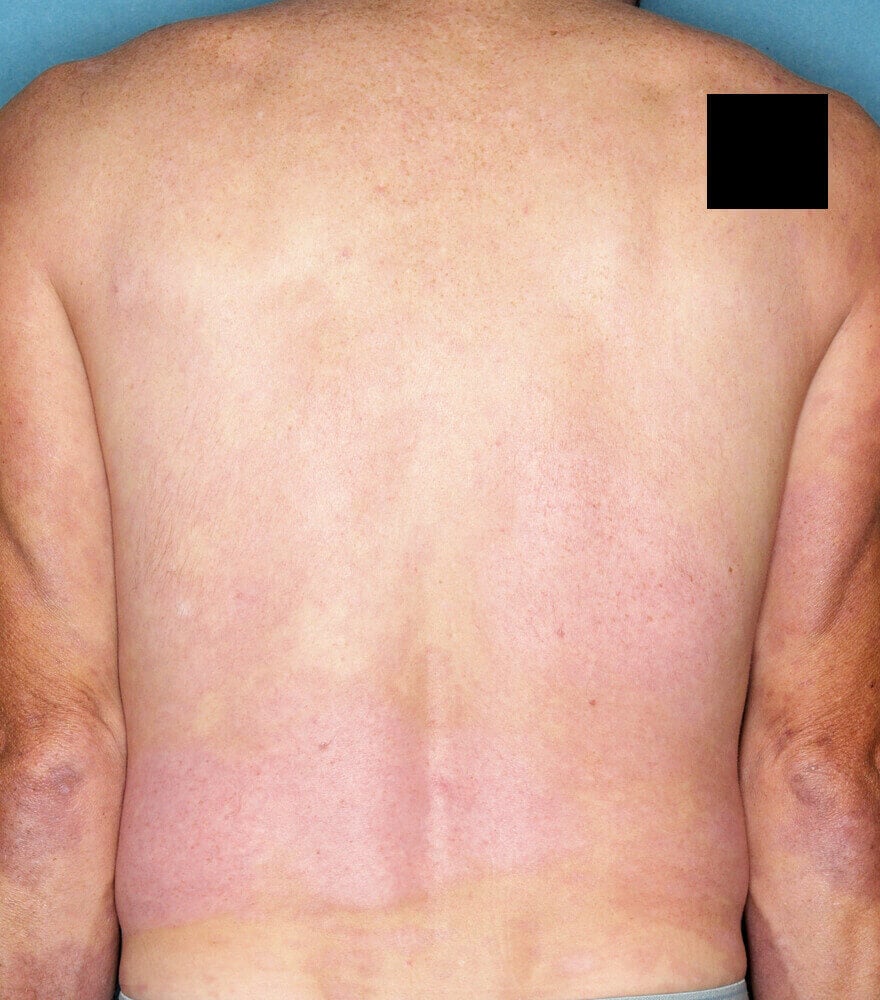 Psoriasis patient photos: 64% BSA before vs 0% BSA after 12 weeks with SILIQ