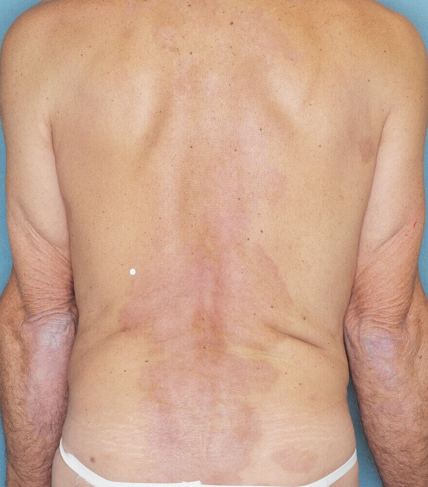 Psoriasis patient photos: 30% BSA before vs 0% BSA after 12 weeks with SILIQ