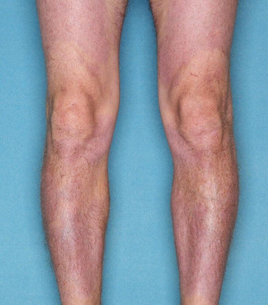 Psoriasis patient photos: 64% BSA before vs 0% BSA after 12 weeks with SILIQ