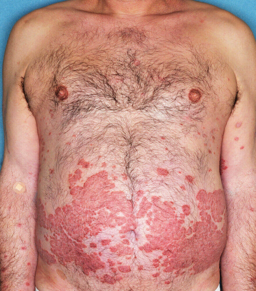 Psoriasis patient photos: 28% BSA before vs 0% BSA after 12 weeks with SILIQ