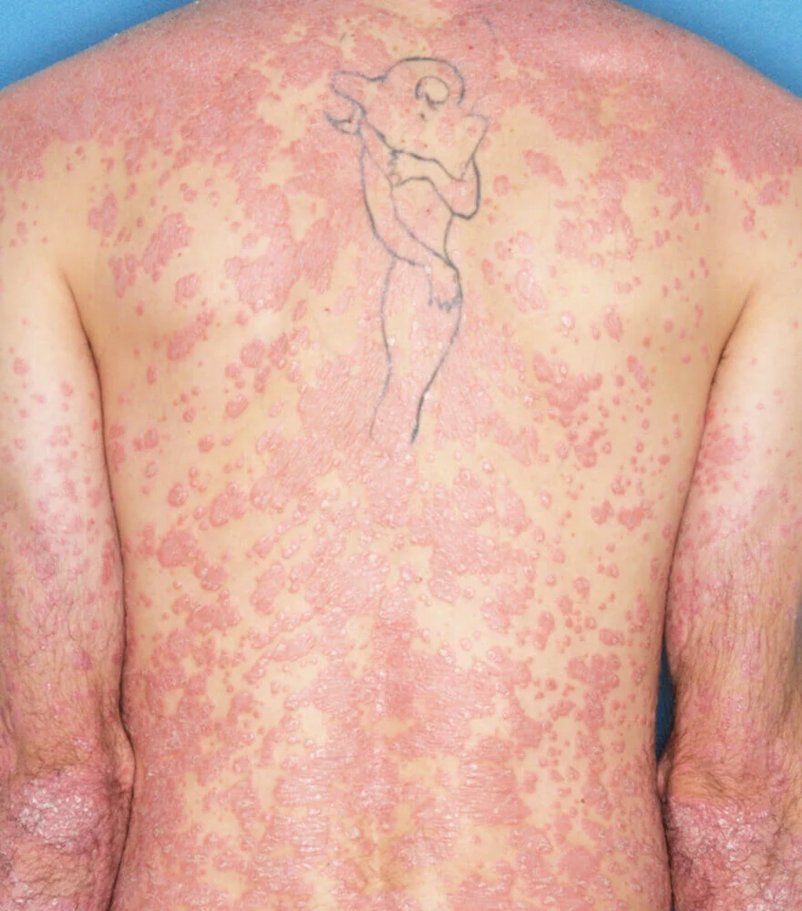 Psoriasis patient photos: 53% BSA before vs 0% BSA at 12 weeks with SILIQ