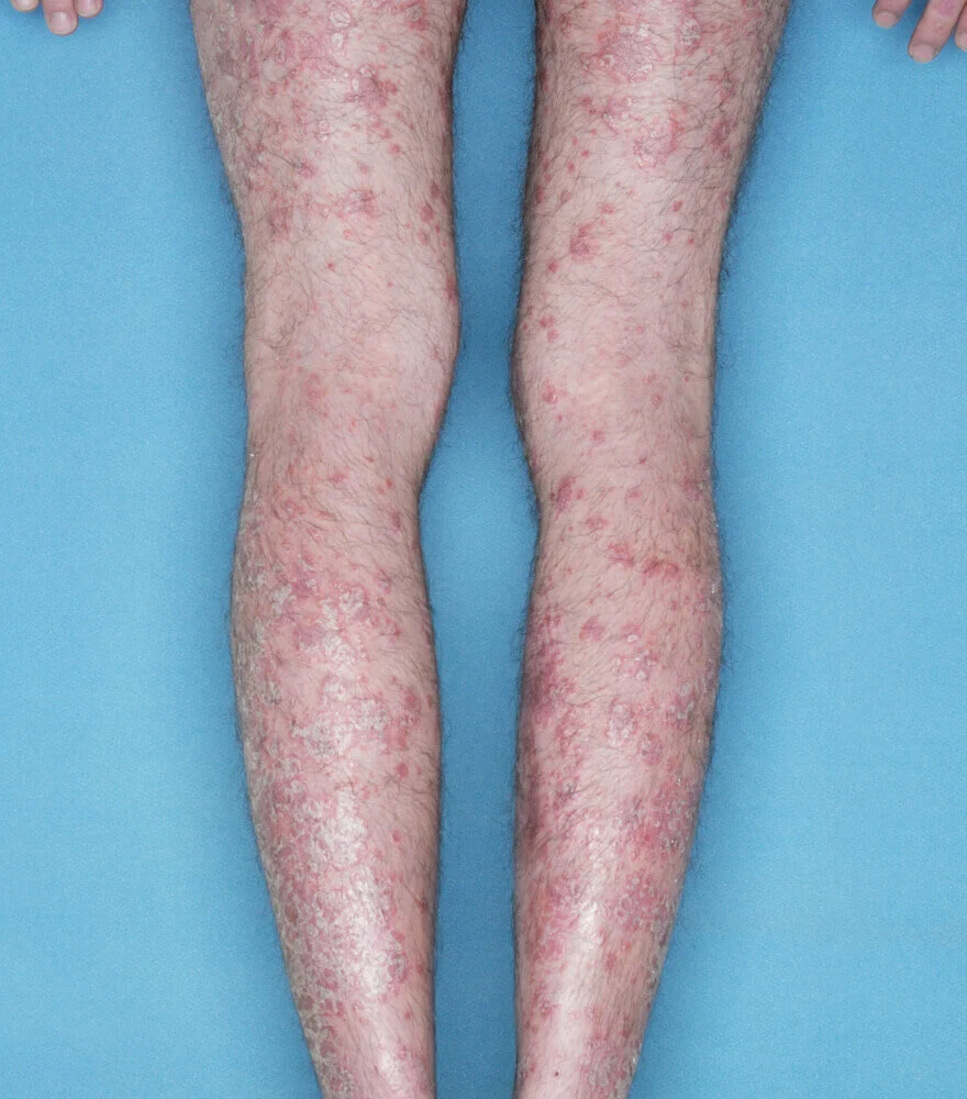 Psoriasis patient photos: 53% BSA before vs 0% BSA after 12 weeks with SILIQ