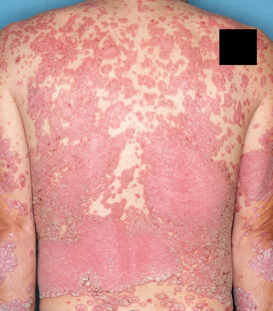 Psoriasis patient photos: 64% BSA before vs 0% BSA after 12 weeks with SILIQ