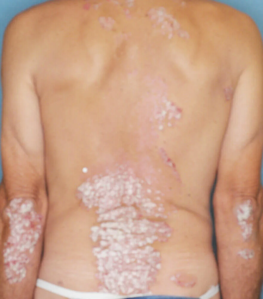 Psoriasis patient photos: 30% BSA before vs 0% BSA after 12 weeks with SILIQ