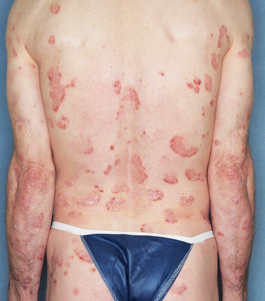 Psoriasis patient photos: 15% BSA before vs 0% BSA after 12 weeks with SILIQ