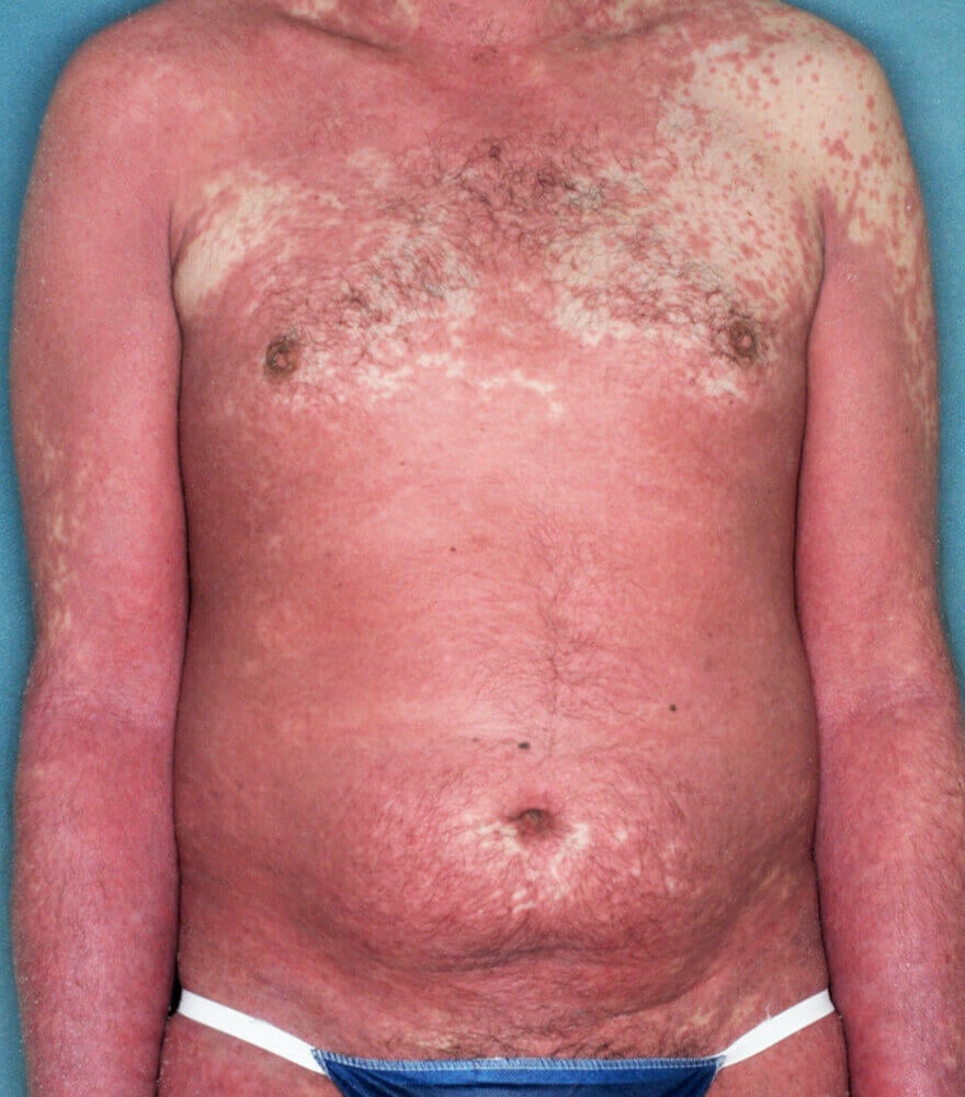 Psoriasis patient photos: 92% BSA before vs 0% BSA after 12 weeks with SILIQ
