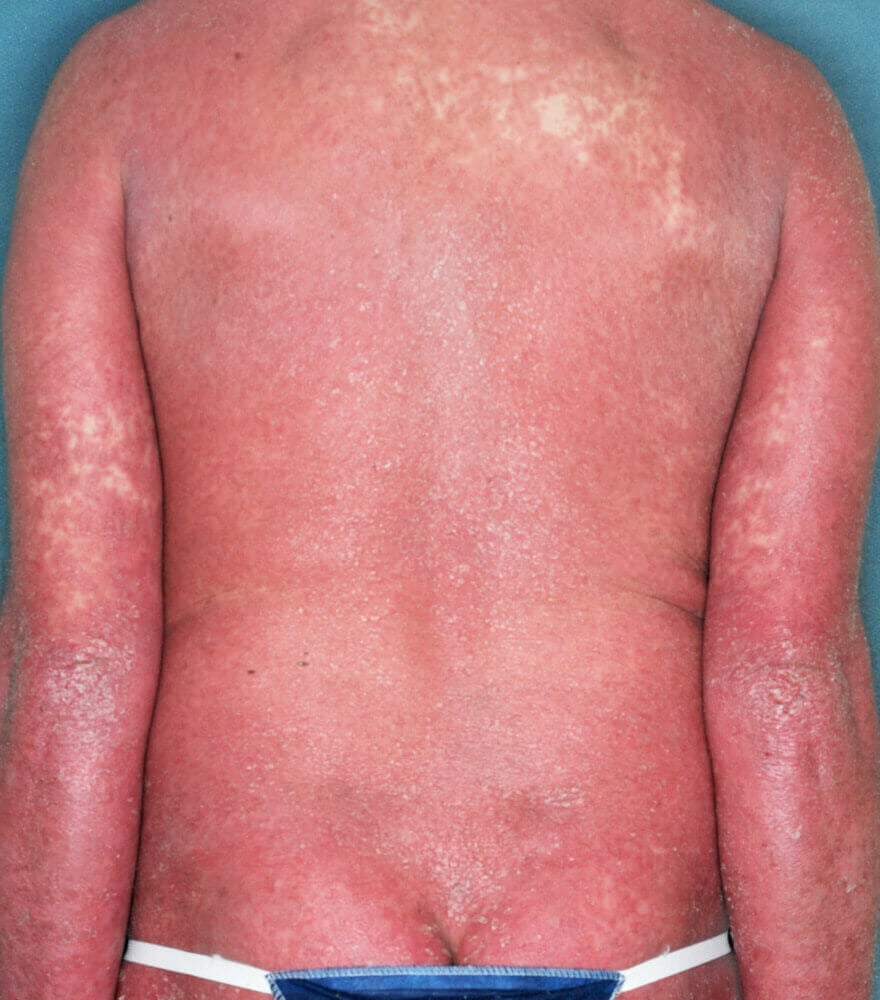 Psoriasis patient photos: 92% BSA before vs 0% BSA after 12 weeks with SILIQ