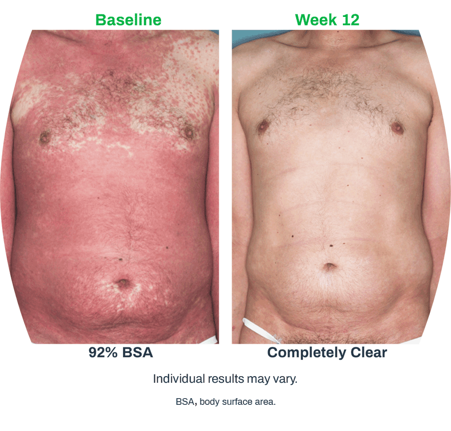 Psoriasis patient photos: 92% BSA before vs completely clear at Week 12 with SILIQ