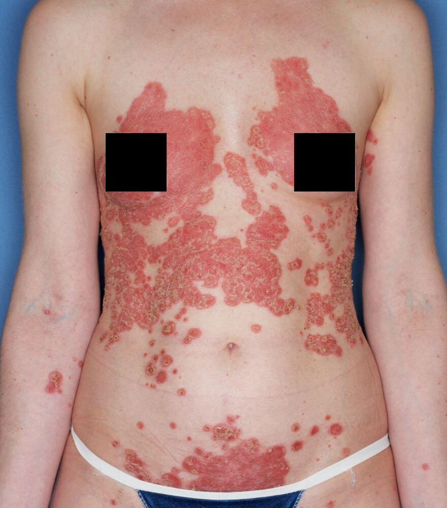 Psoriasis patient photos: 20% BSA before vs 0% BSA after 52 weeks with SILIQ