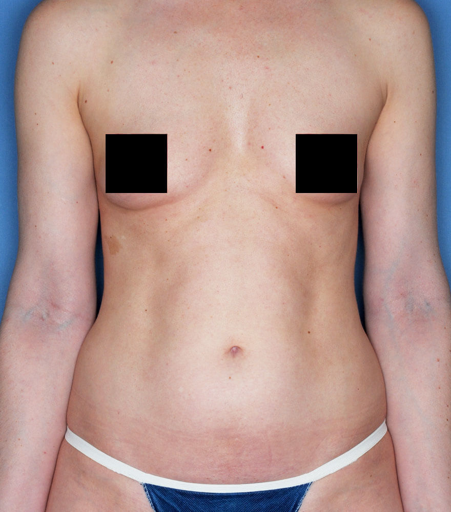 Psoriasis patient photos: 30% BSA before vs 0% BSA after 1 year with SILIQ