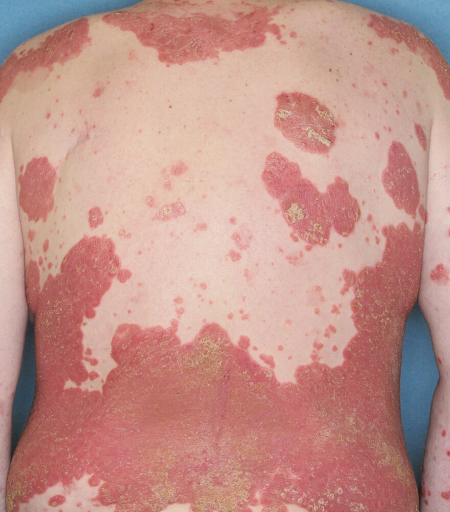 Psoriasis patient photos: 30% BSA before vs 0% BSA after 1 year with SILIQ