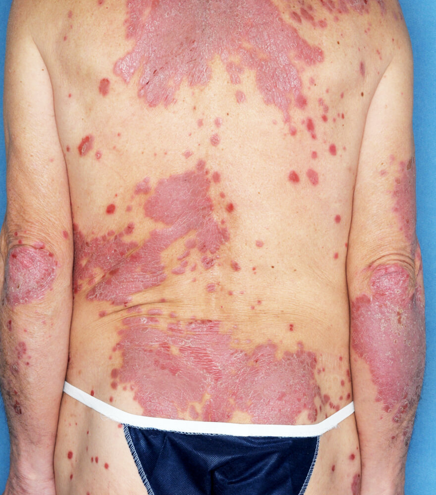 Psoriasis patient photos: 50% BSA before vs 0% BSA after 1 year with SILIQ