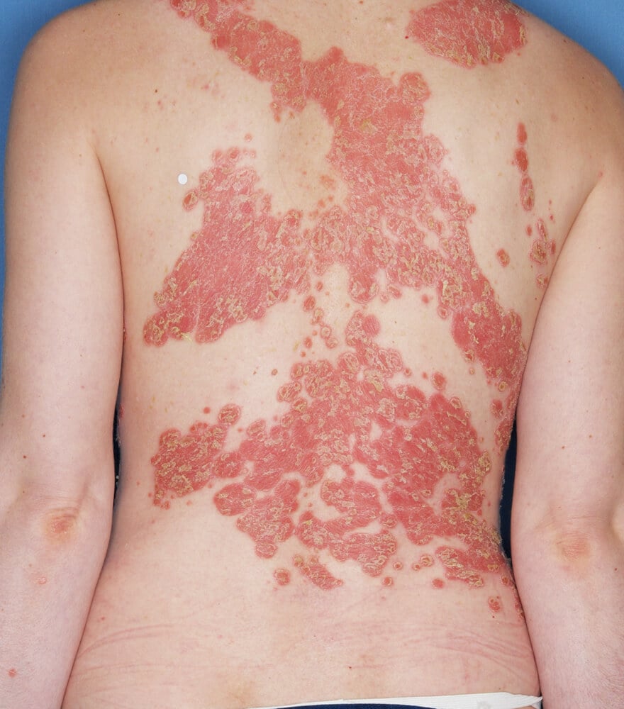 Psoriasis patient photos: 23% BSA before vs 0% BSA after 1 year with SILIQ