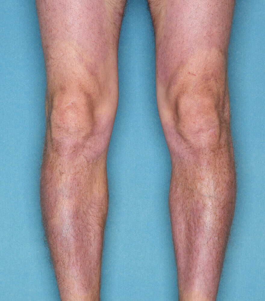 Psoriasis patient photos 30% BSA before vs 0% BSA after 3 months with SILIQ