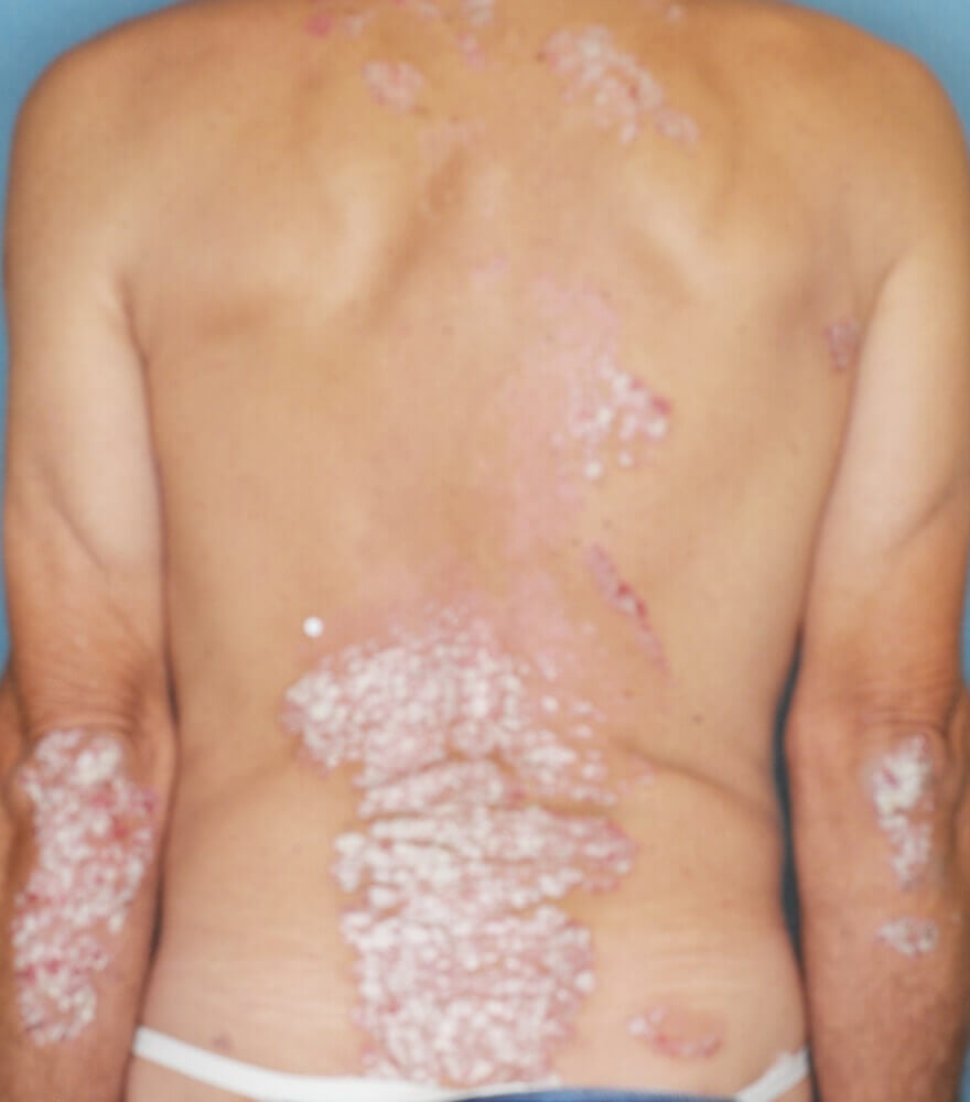 Psoriasis patient photos: 30% BSA before vs 0% BSA after 3 months with SILIQ