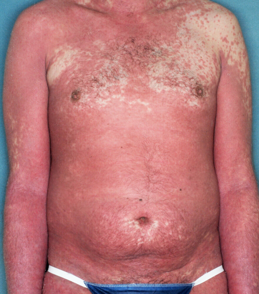 Psoriasis patient photos 15% BSA before vs 0% BSA after 3 months with SILIQ